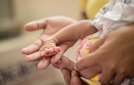 Eine Hand eines Erwachsenen hält einen Fuss eines Kindes, das einen Klumpfuss hat.